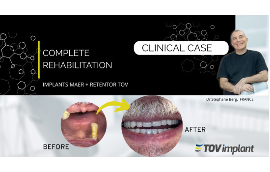 Réhabilitation complète avec implants MAER et système Retentor TOV Implant